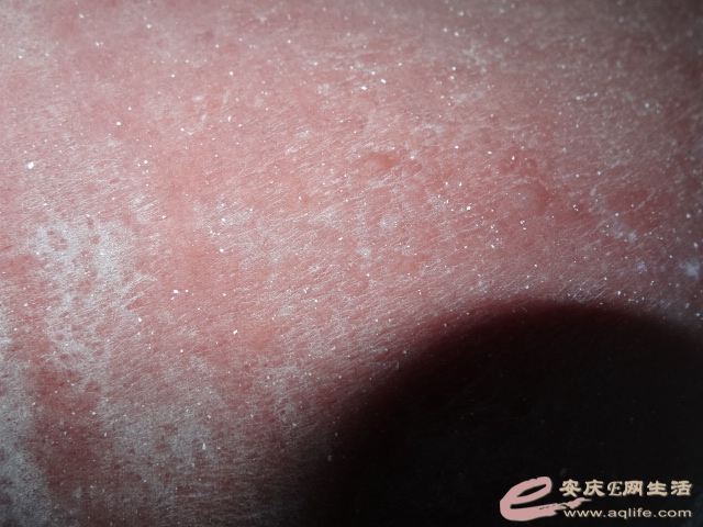 从水上乐园回来,全身又痛又痒起水泡该怎么办